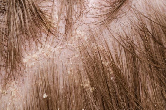 Перхоть – причина выпадения волос